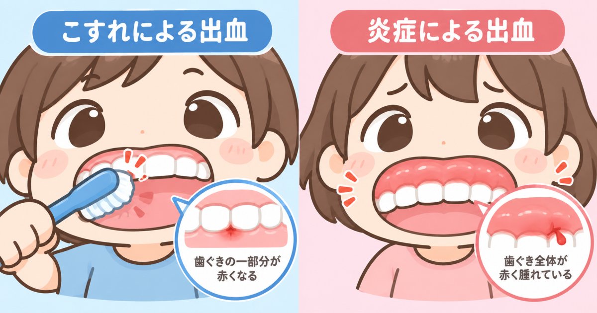 歯ぐきからの出血、磨きすぎと歯肉炎はここで見分ける